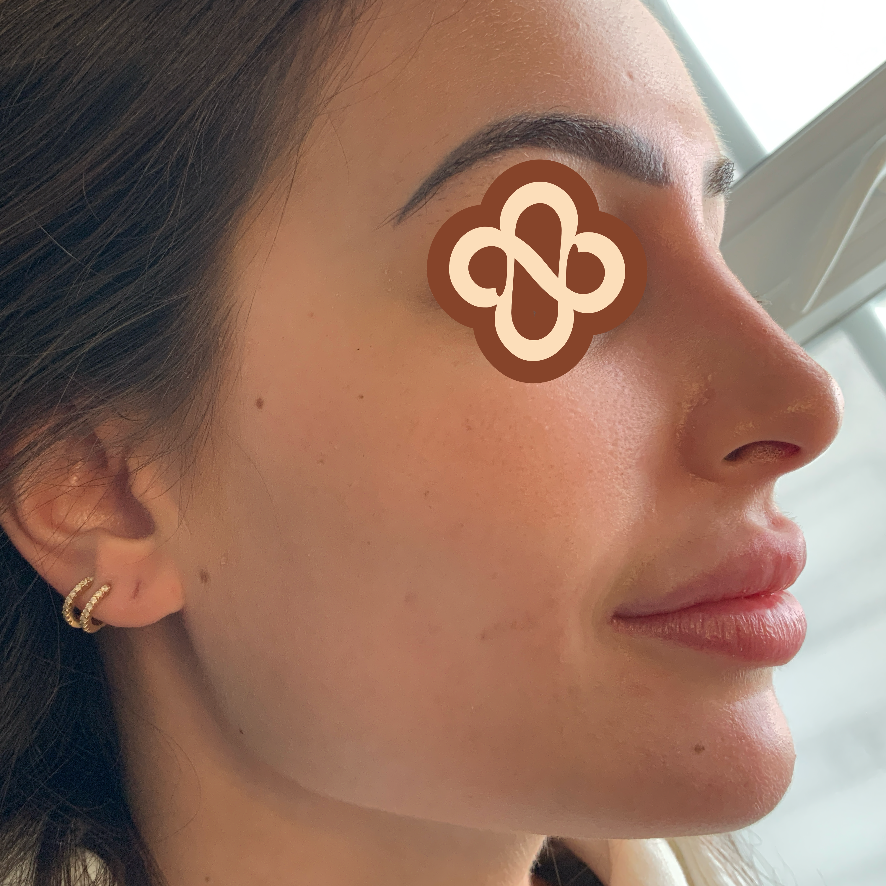 Result after treatment for acne - After