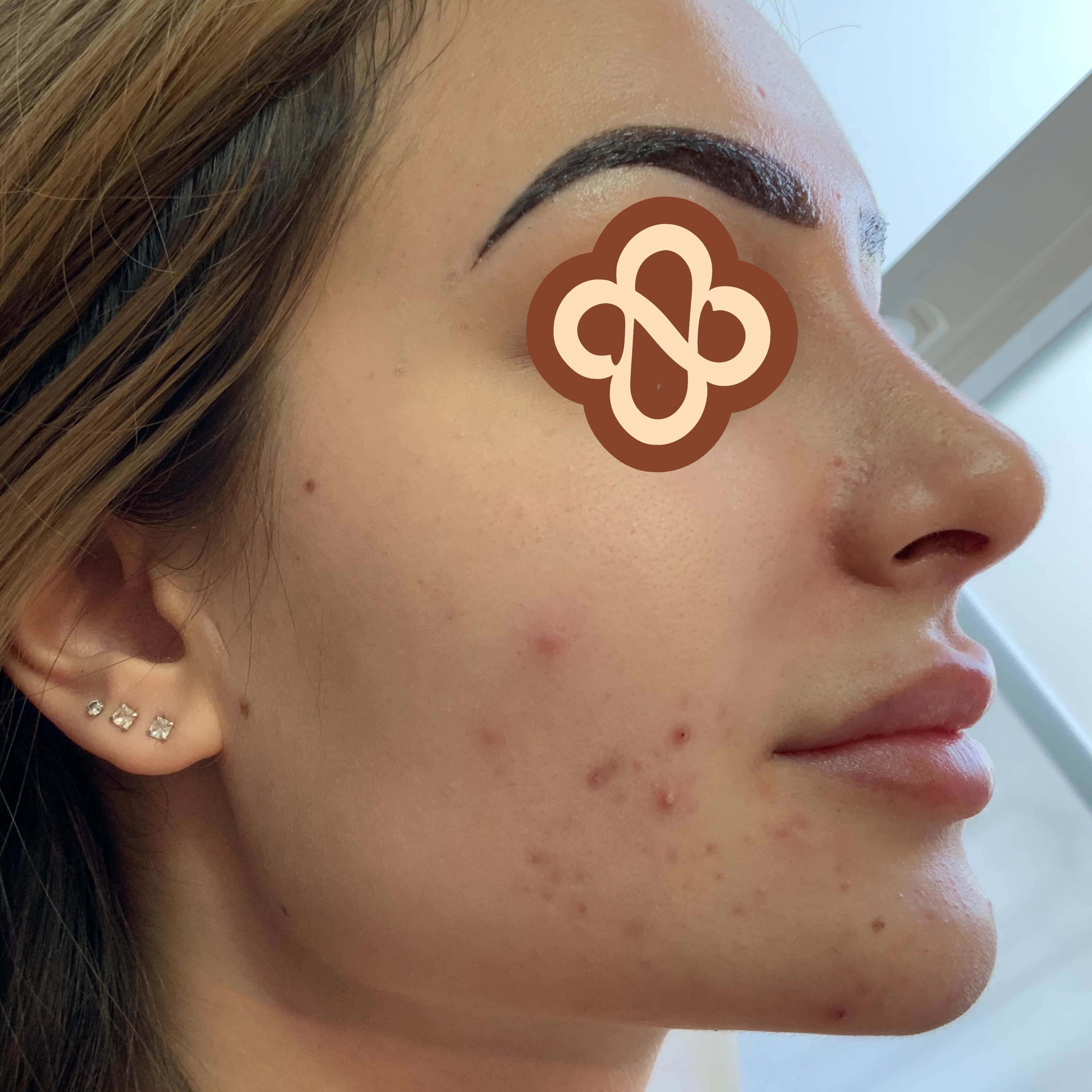 Result after treatment for acne - Before
