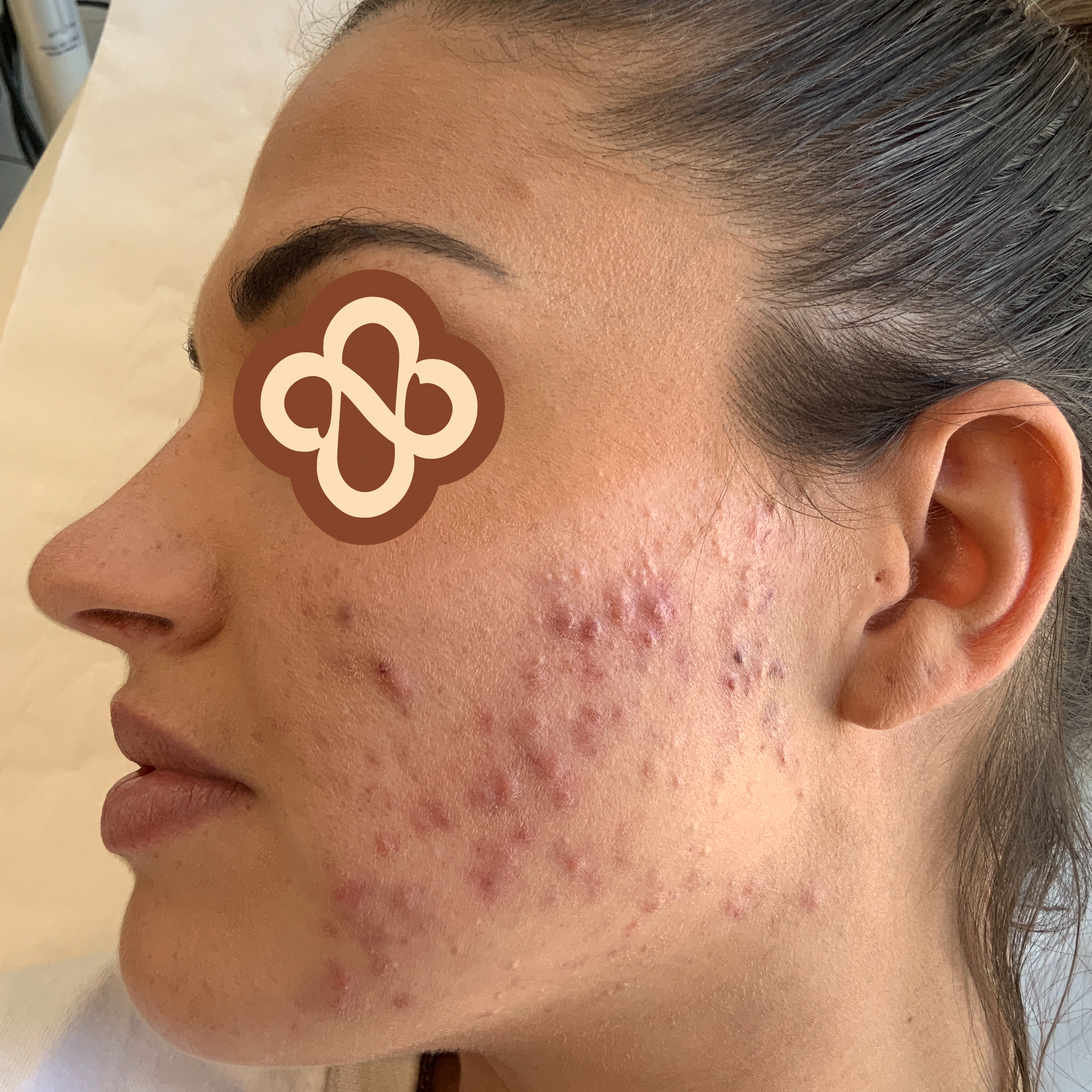 Result after treatment for acne - Before