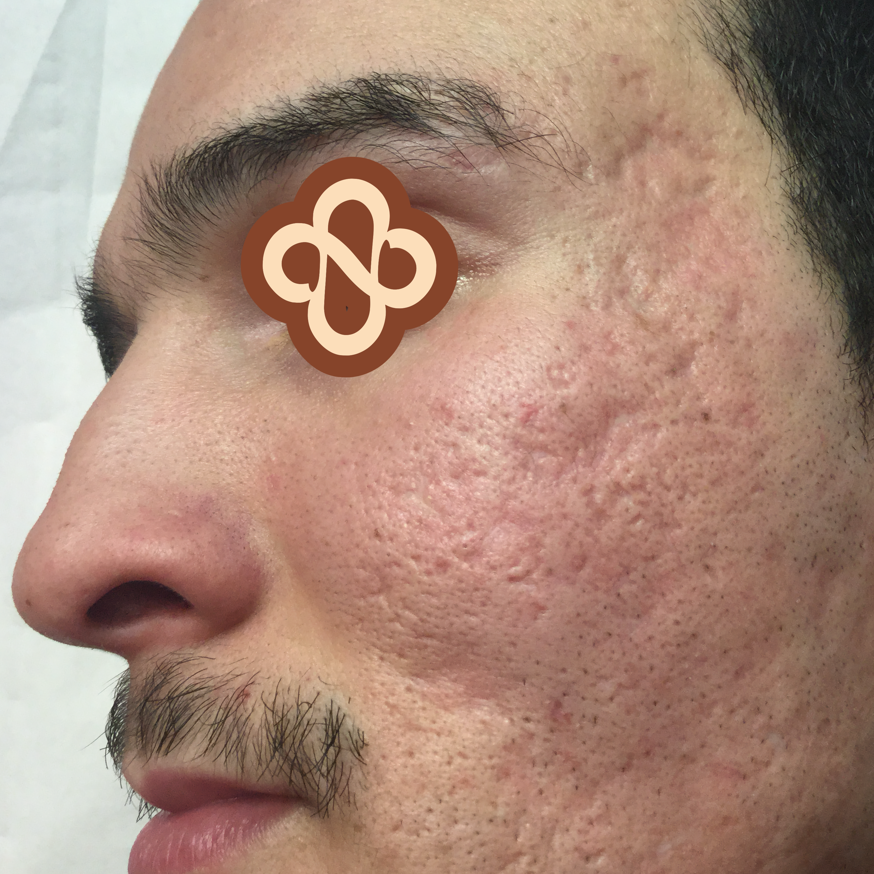 Result after 1 session - Before