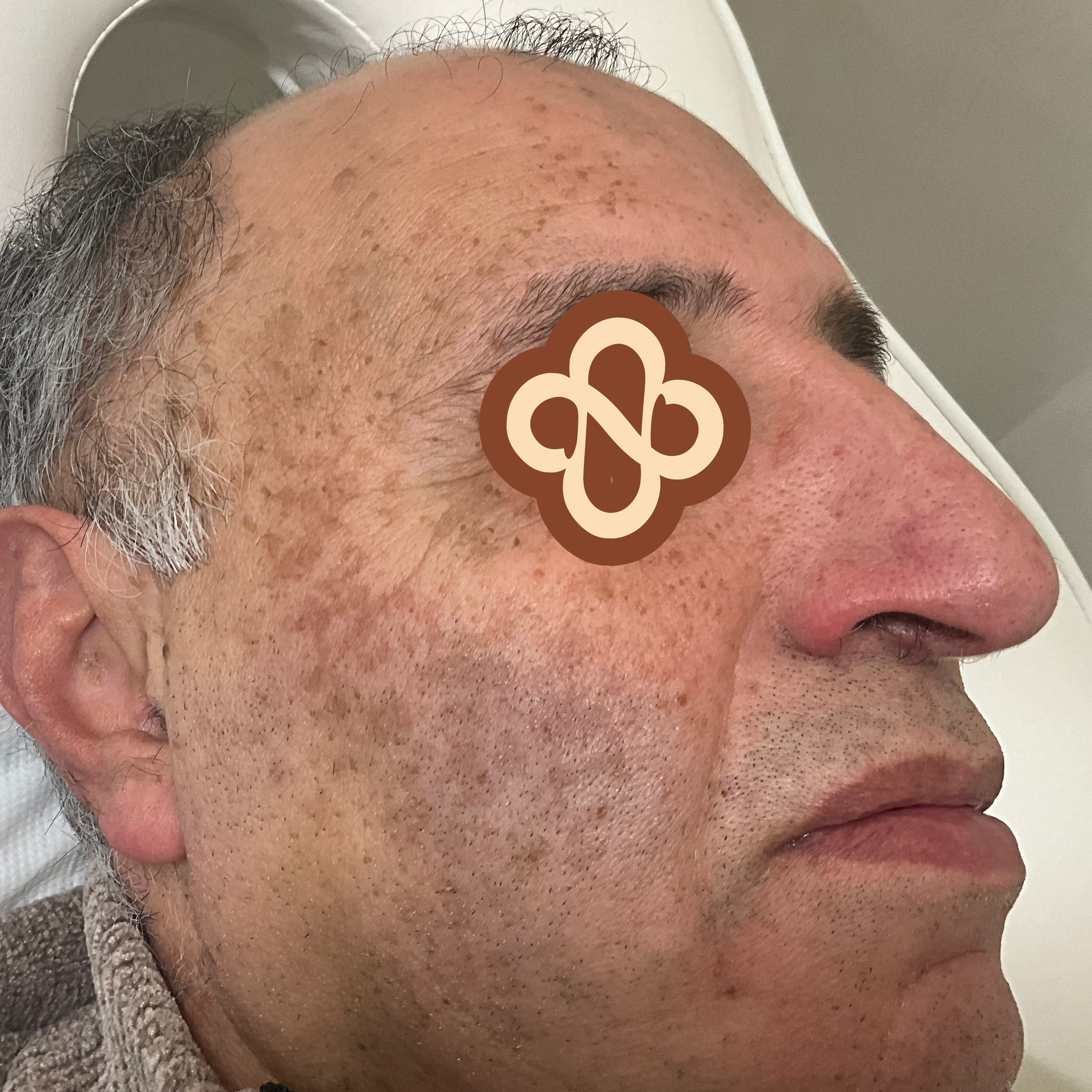 Result after treatment - After