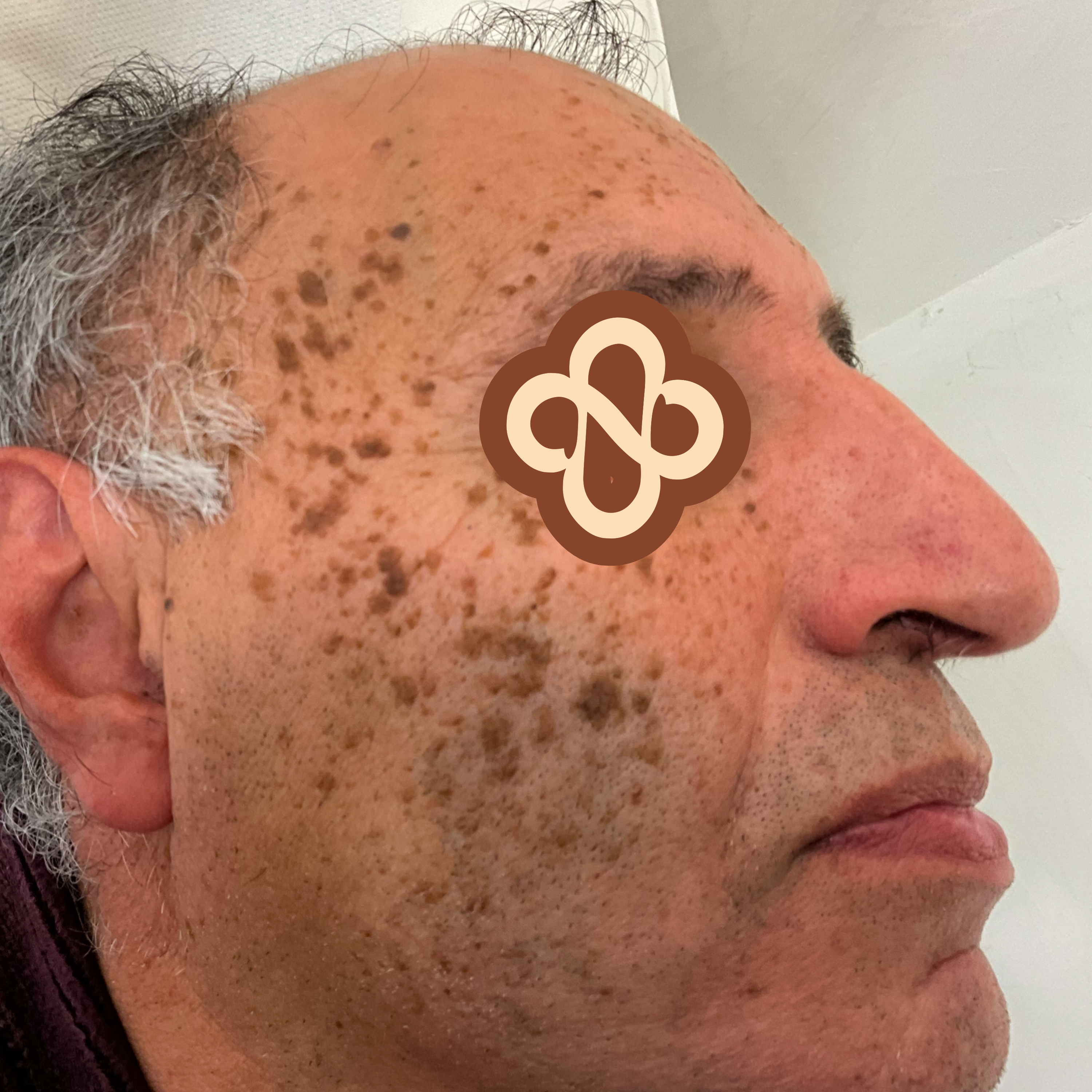 Result after treatment - Before