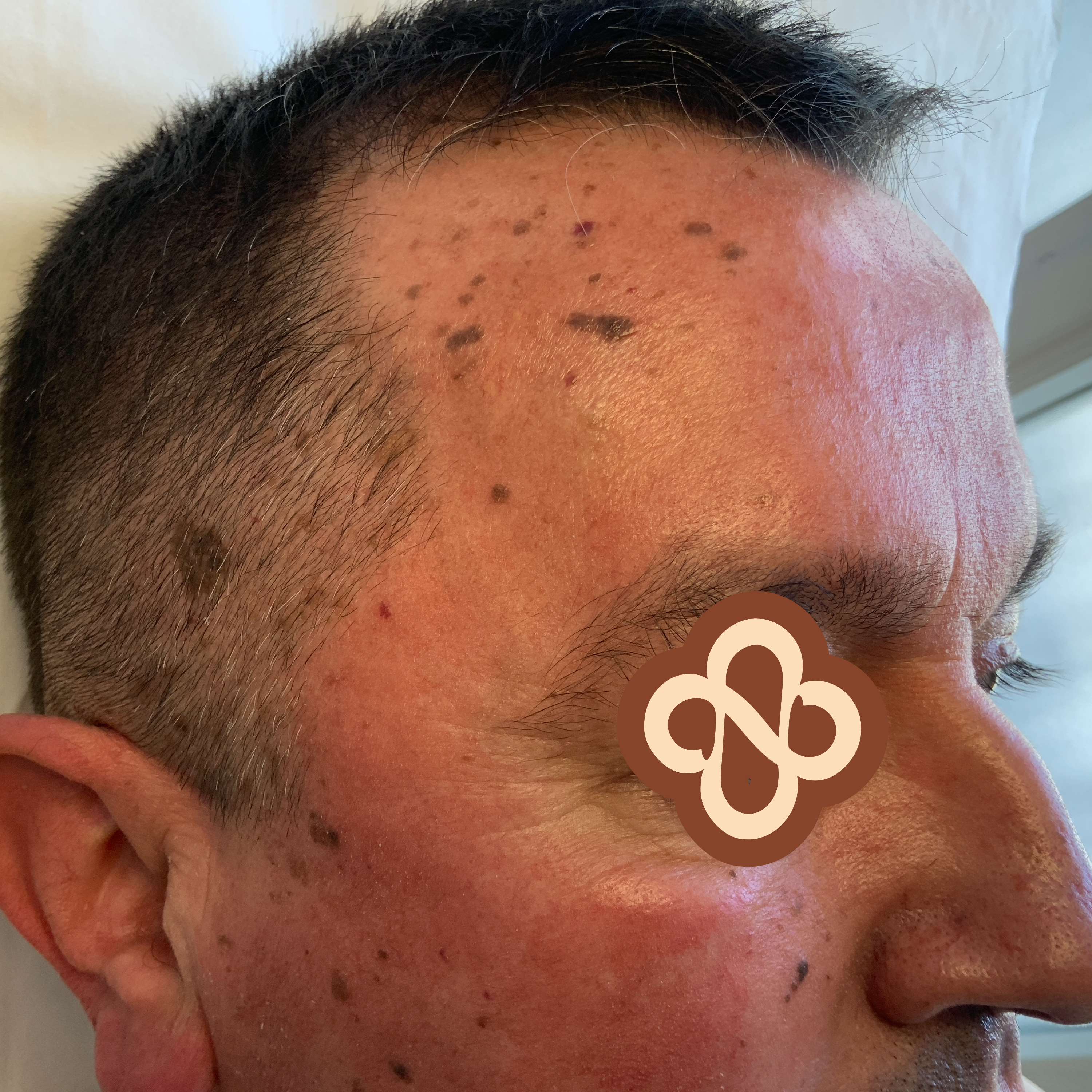 Result after 3 months - Before
