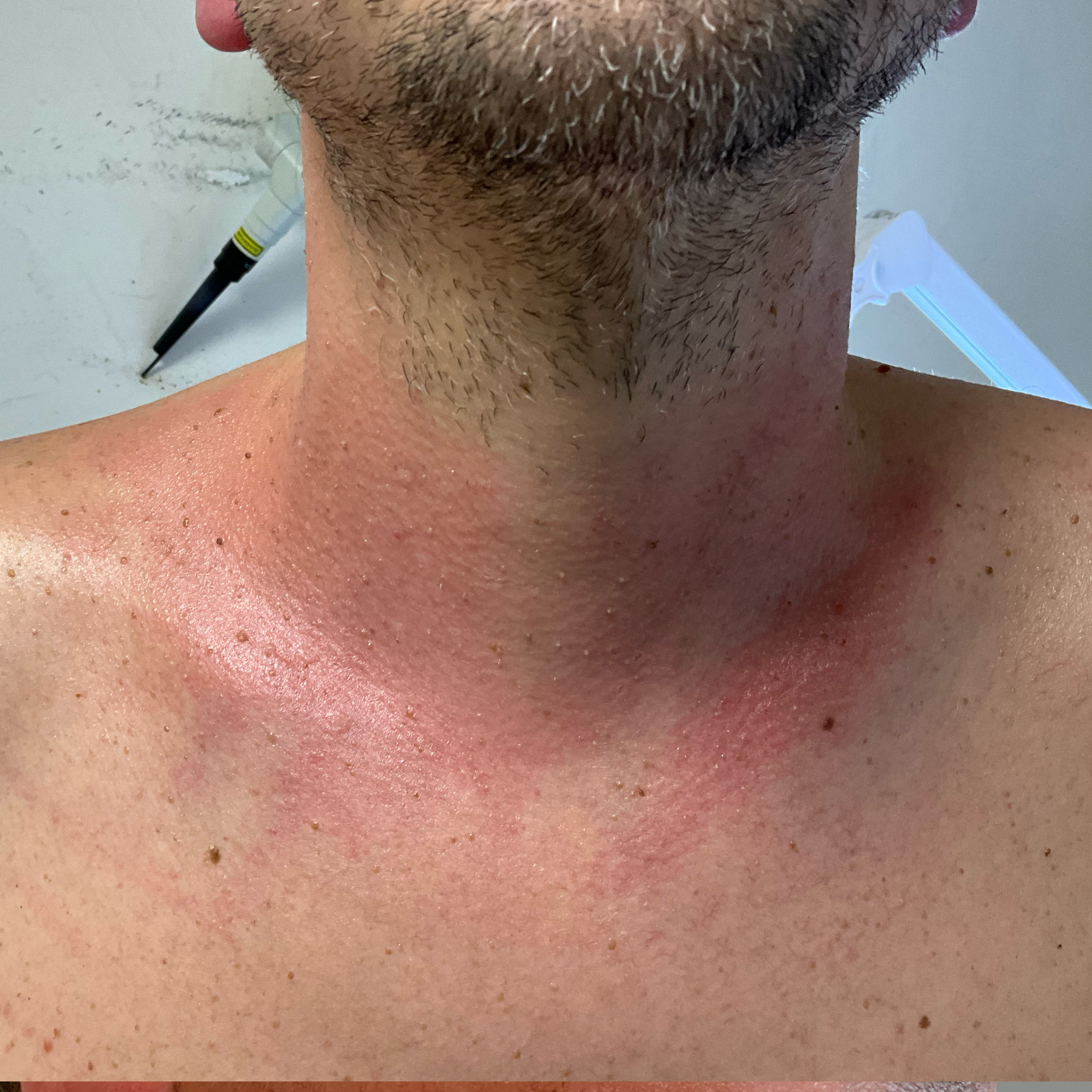 Result after treatment for skin tags - After