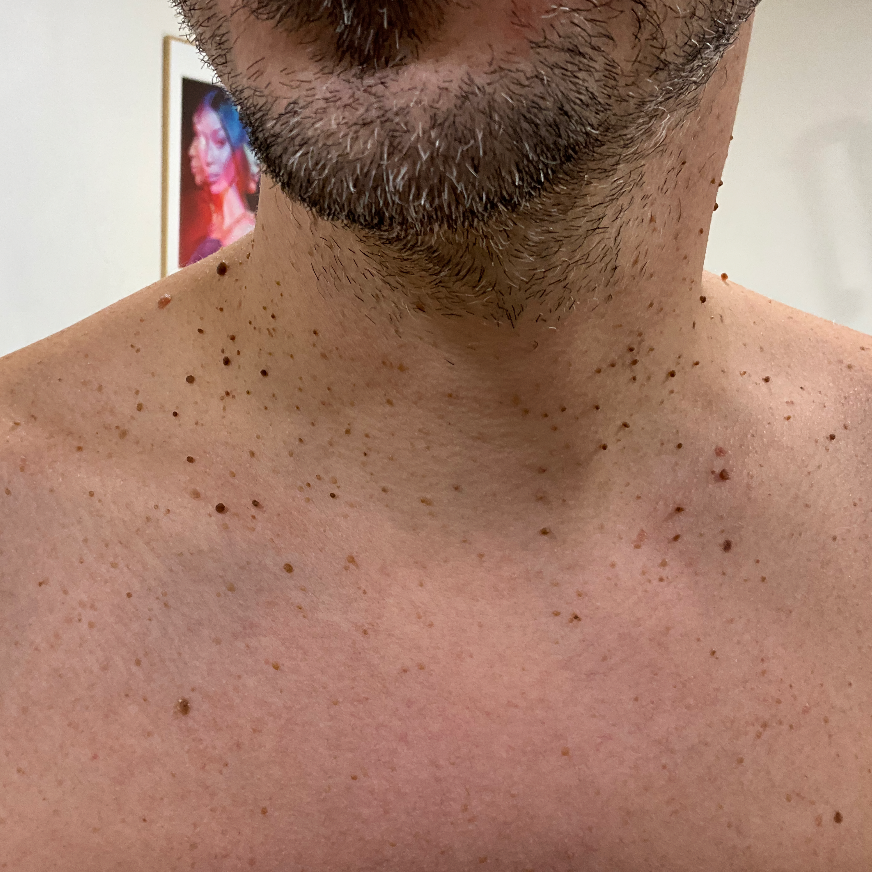 Result after treatment for skin tags - Before