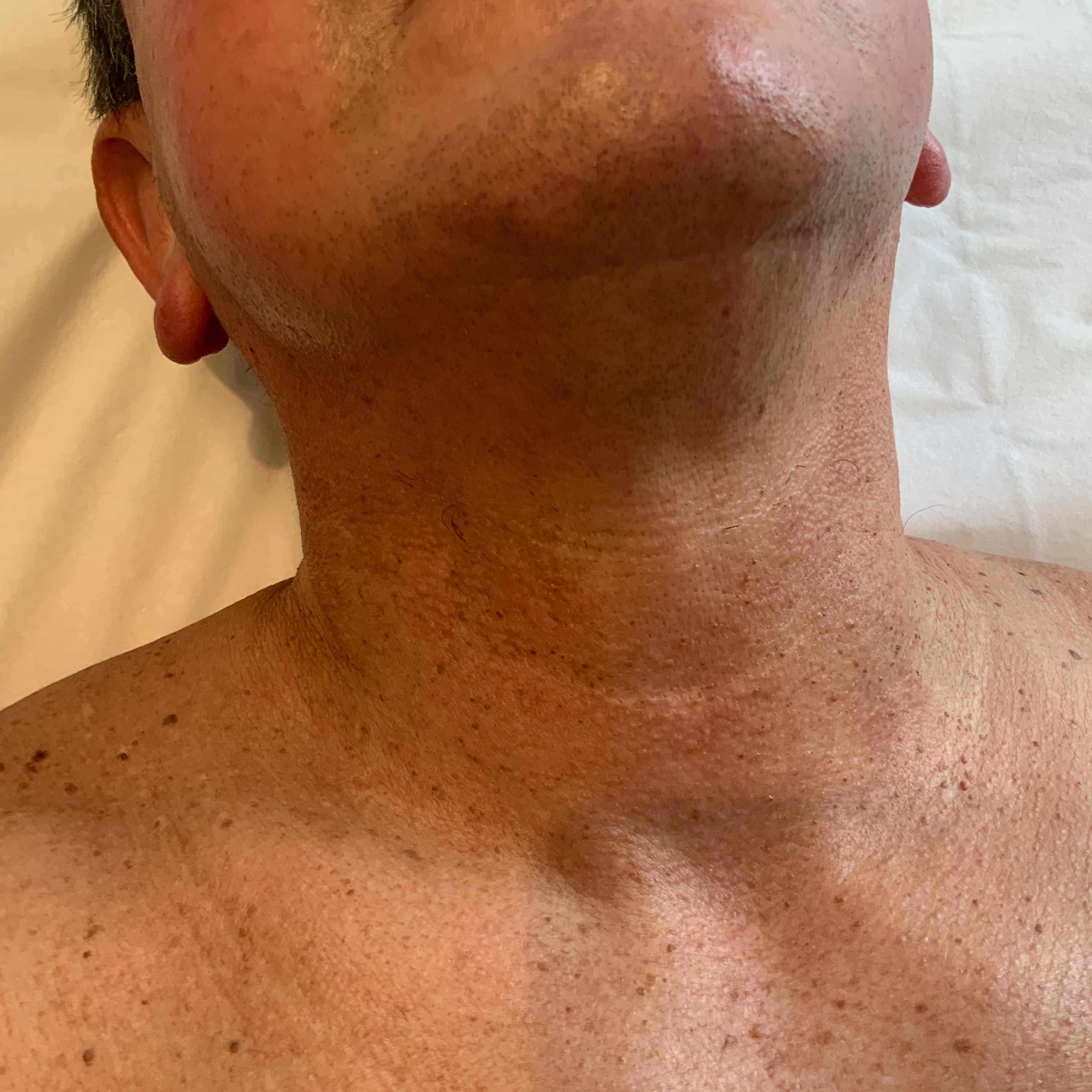 Result after treatment for skin tags - After