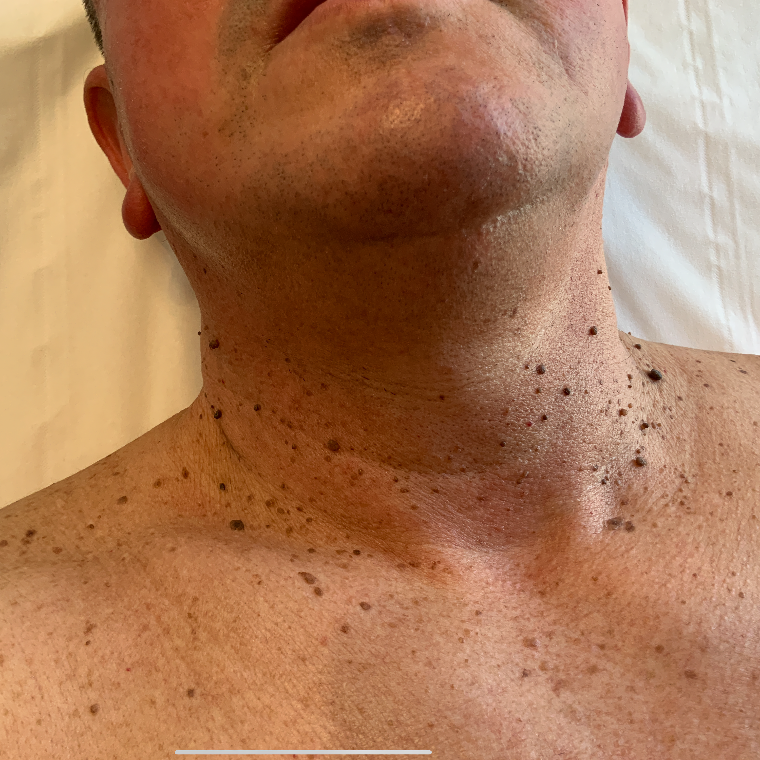 Result after treatment for skin tags - Before
