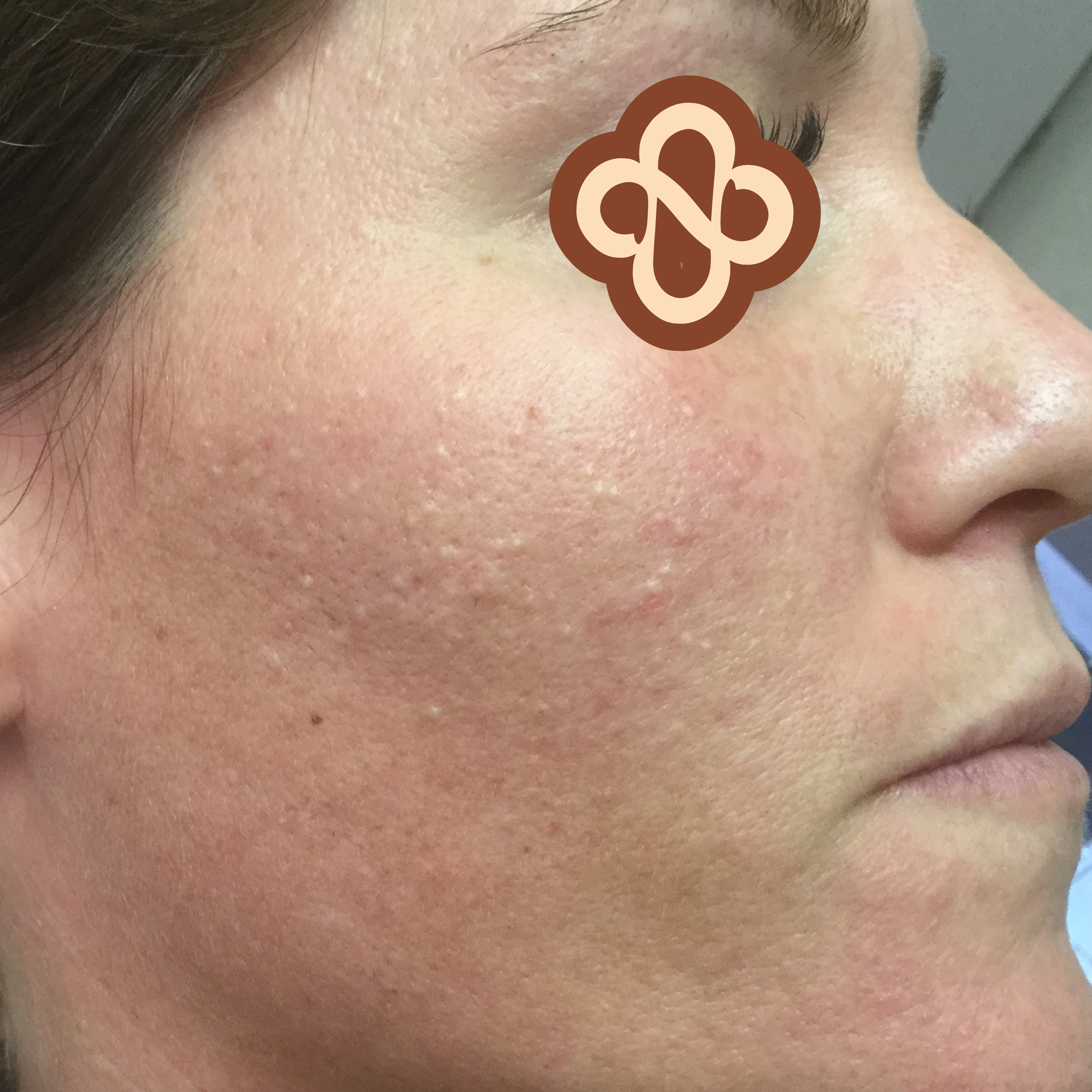 Result after treatment - Before
