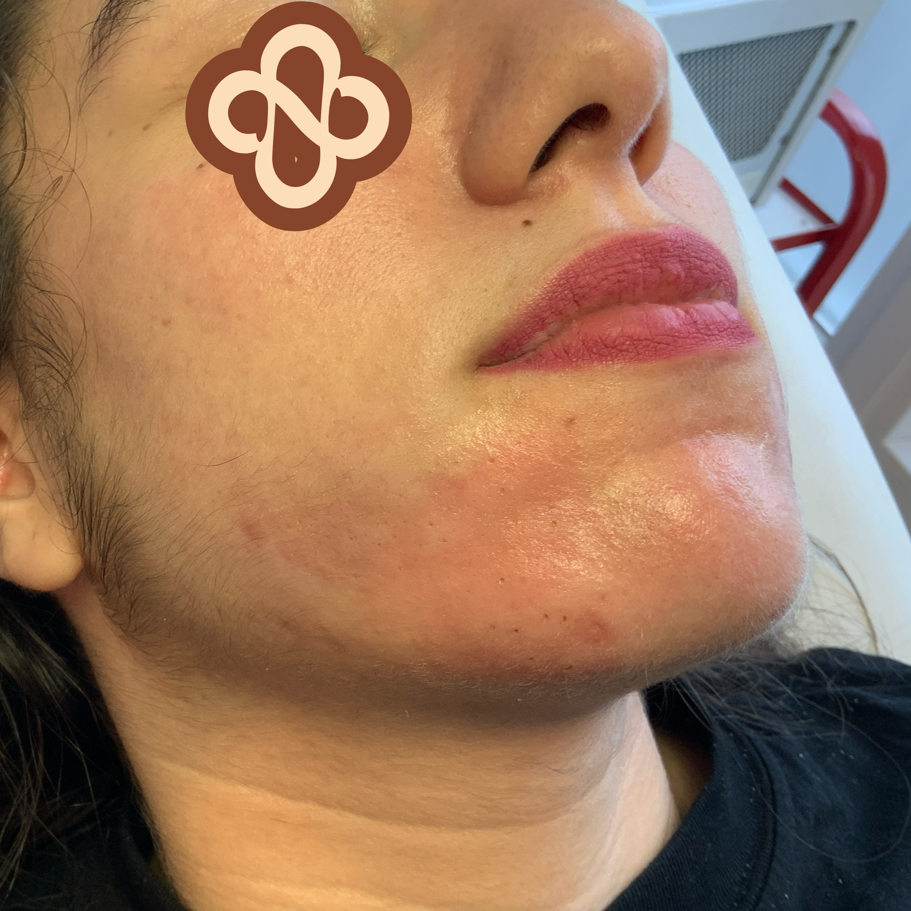 Result after treatment - After