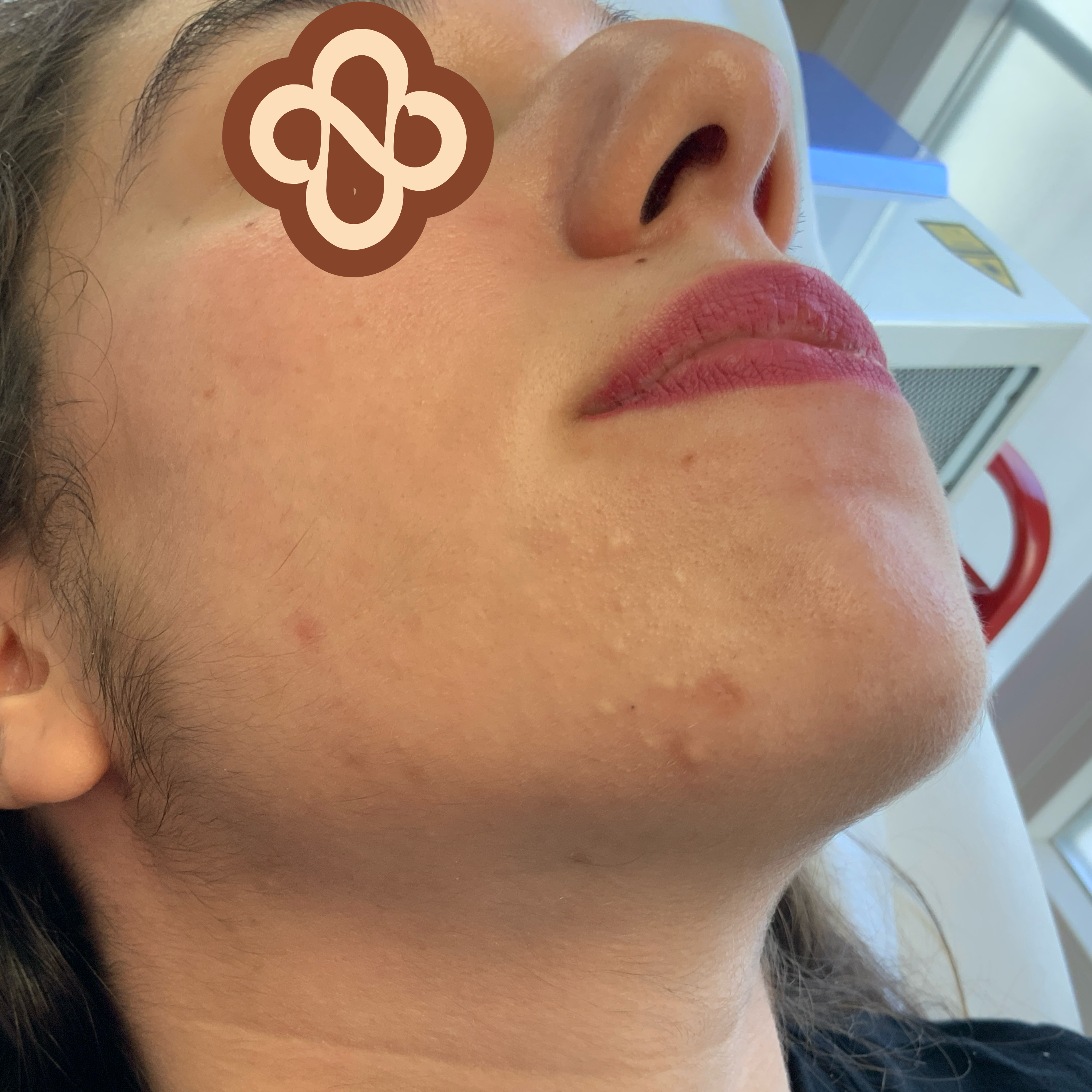 Result after treatment - Before