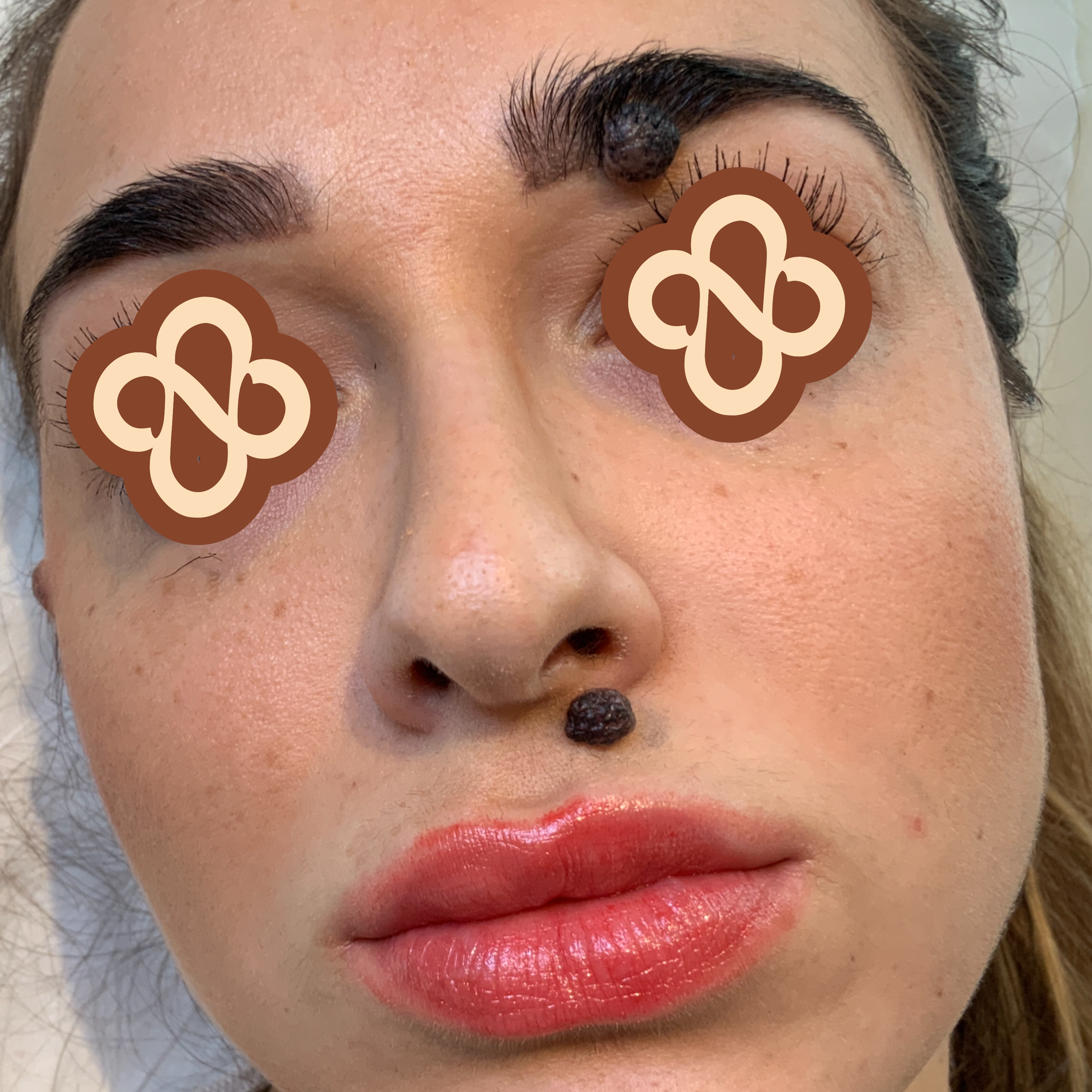 Result after treatment - Before