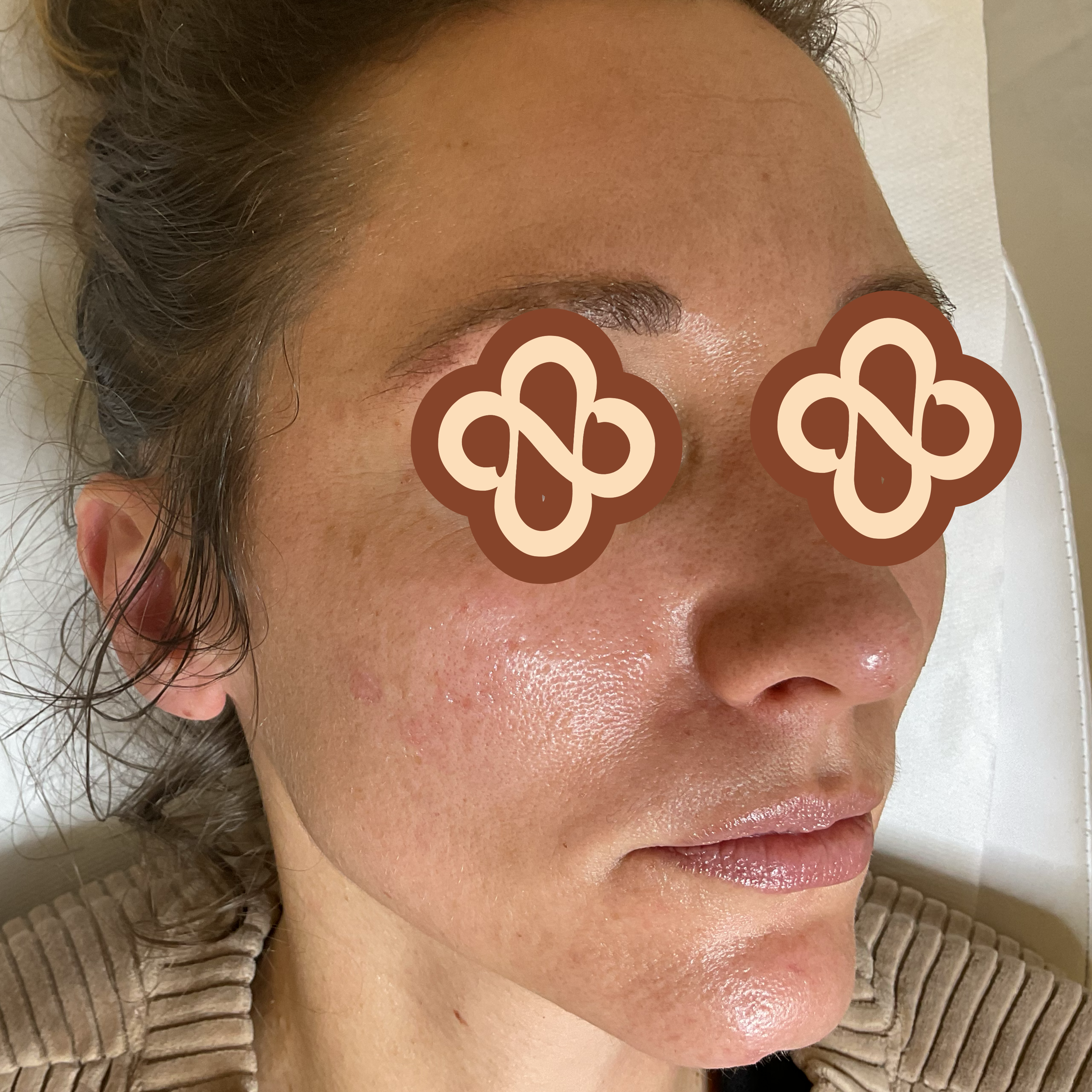Result after treatment - After
