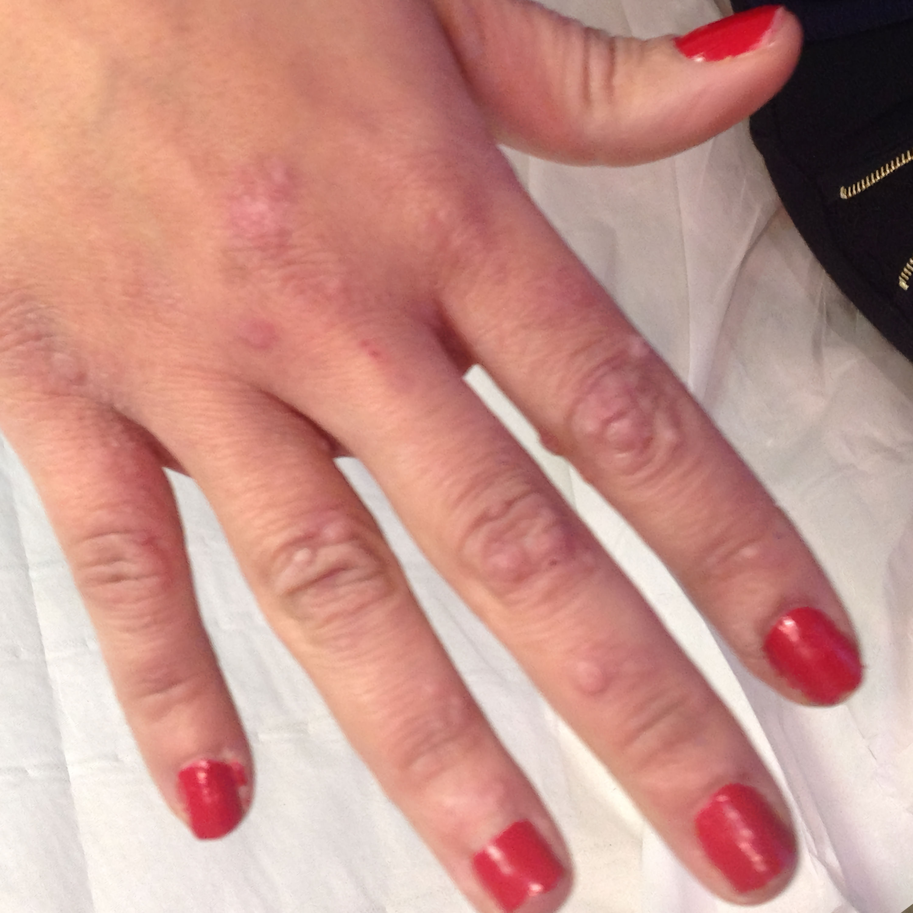Result after treatment - After