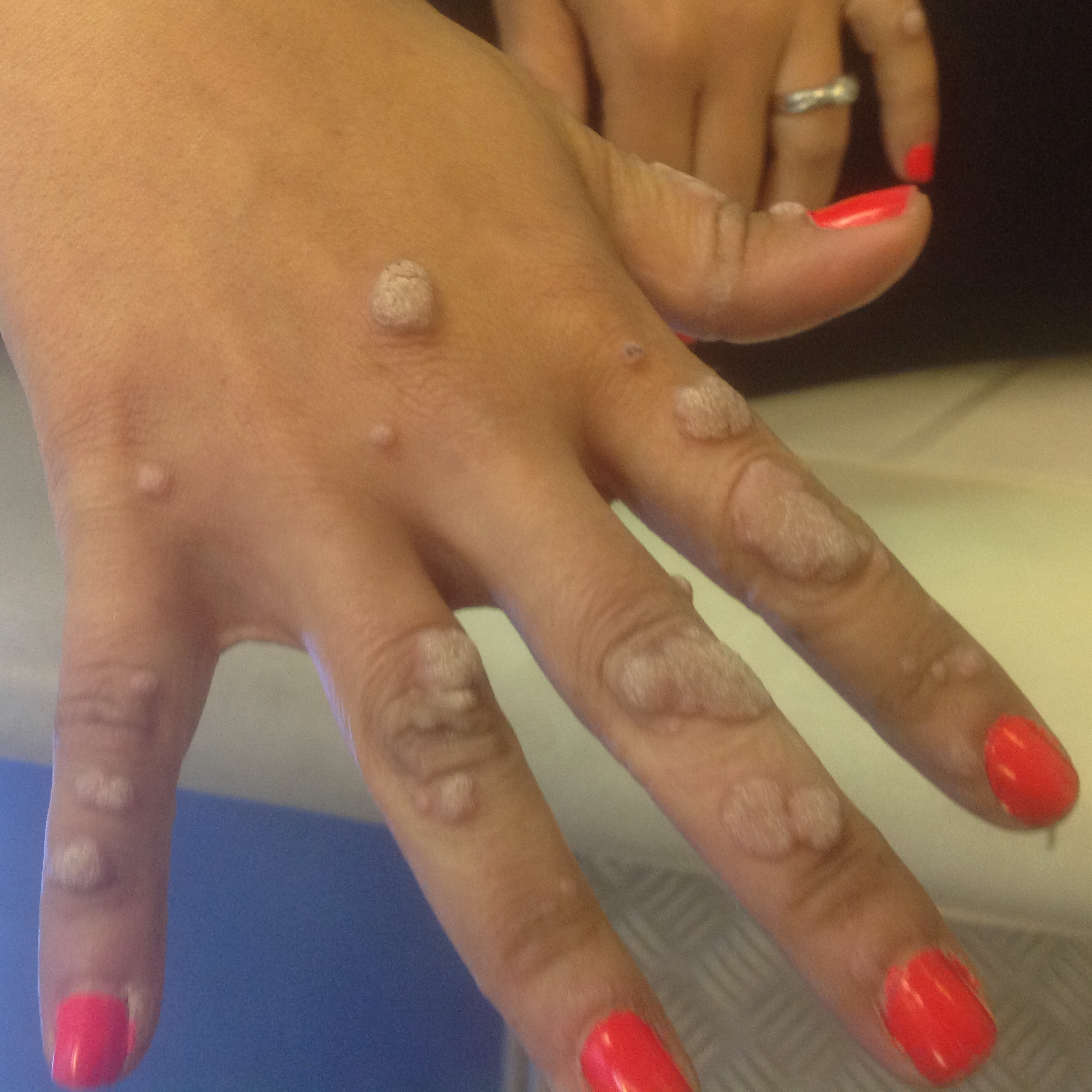 Result after treatment - Before