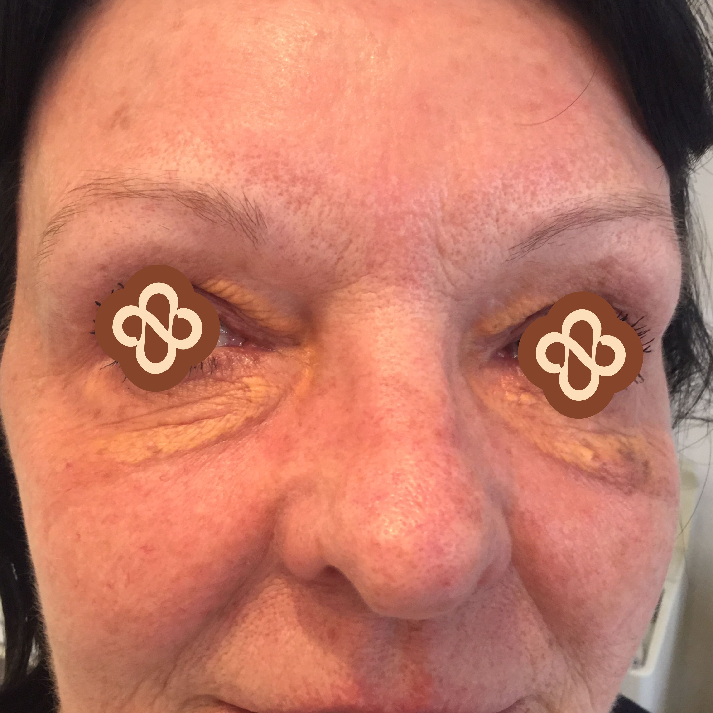 Result after treatment - Before